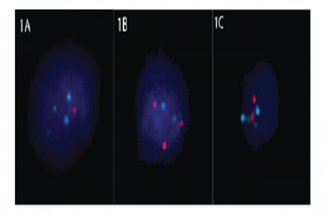 FISH results of interphase cells (a) Cell with monosomy of chromosome 21 (b) Cell with trisomy of chromosome 21 (c) Cell with disomy of chromosome 21. Colour Legend: RED - chromosome 21; Green - chromosome 13; Blue - chromosome 18. [full page width].